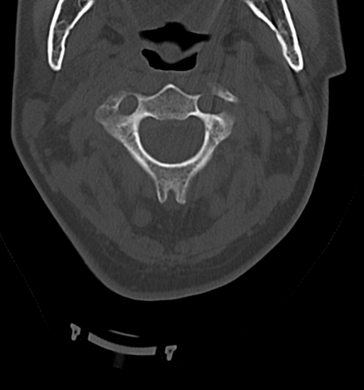 Chordoma (C4 vertebra) (Radiopaedia 47561-52188 Axial bone window 14).png