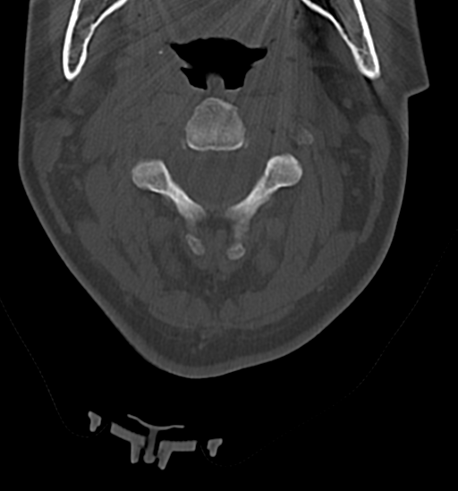 Chordoma (C4 vertebra) (Radiopaedia 47561-52188 Axial bone window 16).png