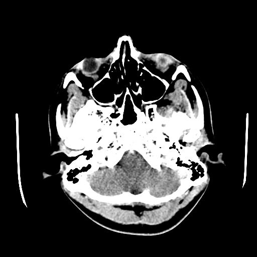 File:Choriocarcinoma of ovary with cerebral and pulmonary metastases (Radiopaedia 25983-26118 C+ arterial phase 13).jpg