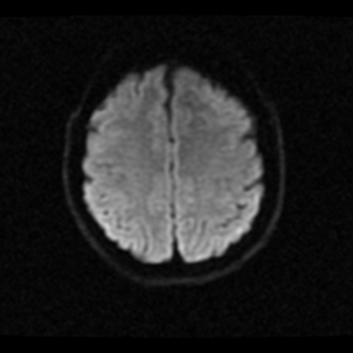 File:Choroid plexus xanthogranuloma (Radiopaedia 17650-17386 DWI 6).jpg