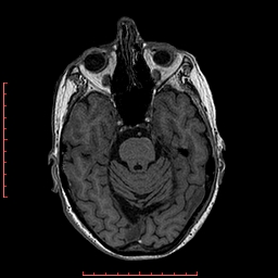 Choroid plexus xanthogranuloma (Radiopaedia 67843-77270 Axial T1 112).jpg