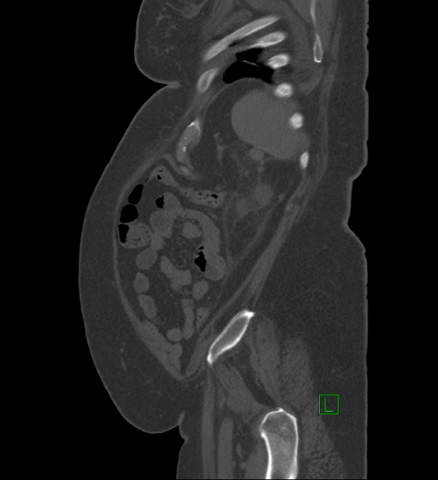 Chromophobe renal cell carcinoma (Radiopaedia 84239-99519 Sagittal bone window 15).jpg
