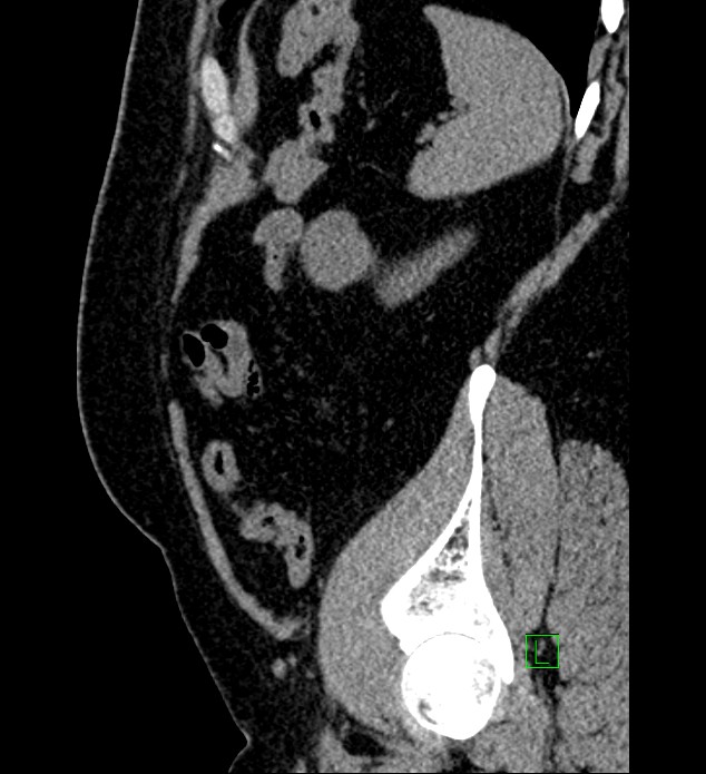 Chromophobe renal cell carcinoma (Radiopaedia 84286-99573 C 29).jpg