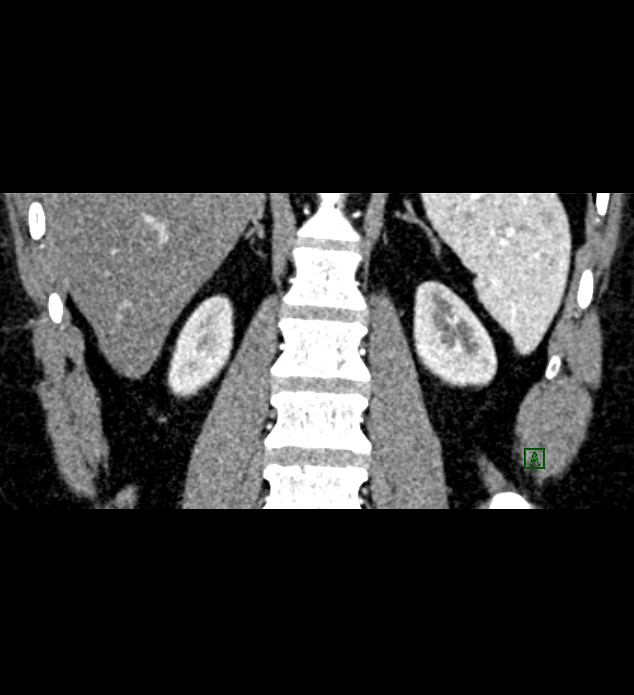 Chromophobe renal cell carcinoma (Radiopaedia 84286-99573 E 67).jpg