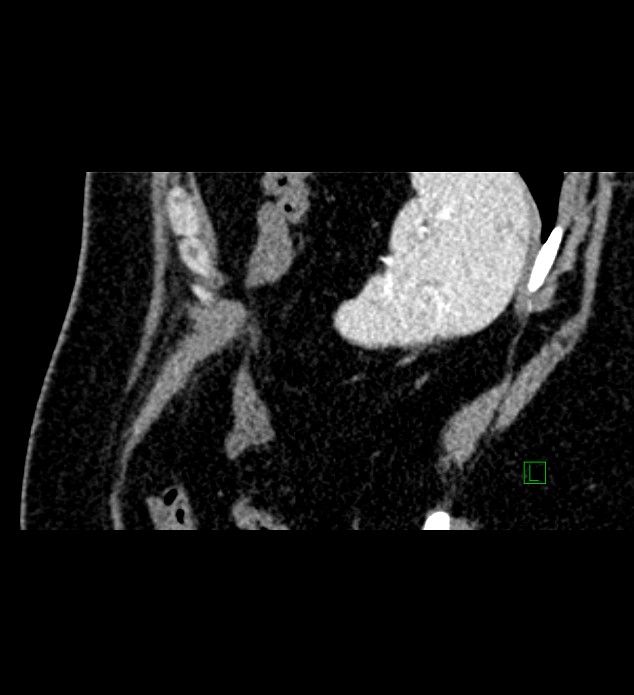 Chromophobe renal cell carcinoma (Radiopaedia 84286-99573 F 19).jpg