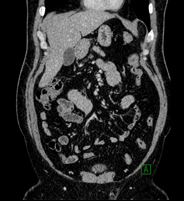 Chromophobe renal cell carcinoma (Radiopaedia 84286-99573 H 55).jpg