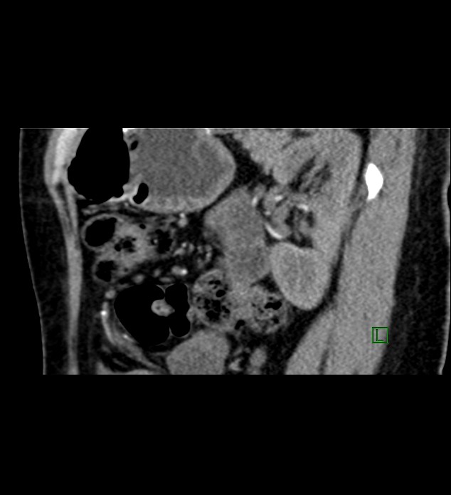 Chromophobe renal cell carcinoma (Radiopaedia 84290-99582 D 31).jpg