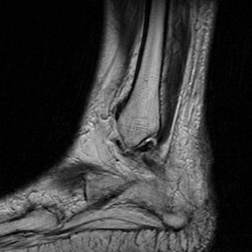 File:Chronic Achilles tendon rupture (Radiopaedia 15262-15100 Sagittal T2 1).jpg
