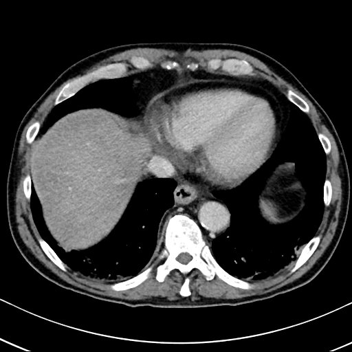 Chronic appendicitis complicated by appendicular abscess, pylephlebitis and liver abscess (Radiopaedia 54483-60700 B 23).jpg