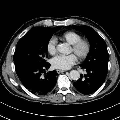 Chronic appendicitis complicated by appendicular abscess, pylephlebitis and liver abscess (Radiopaedia 54483-60700 B 7).jpg
