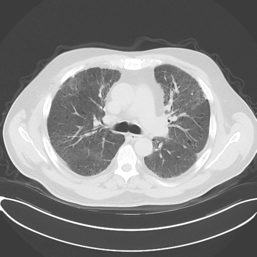 Chronic hypersensitivity pneumonitis (Radiopaedia 48107-52922 Axial lung window 27).png