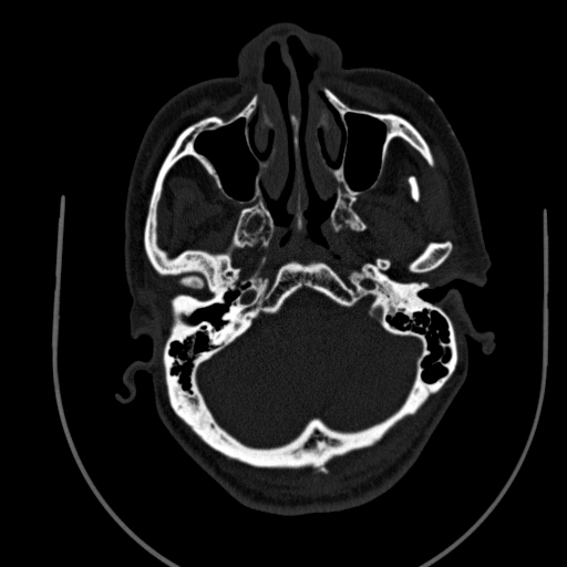 Chronic invasive fungal sinusitis (Radiopaedia 91563-109286 Axial sinus 24).jpg