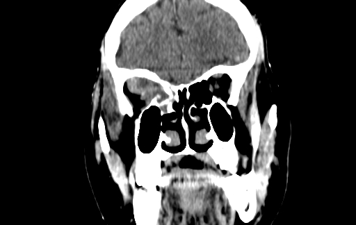 Chronic invasive fungal sinusitis (Radiopaedia 91563-109286 D 45).jpg
