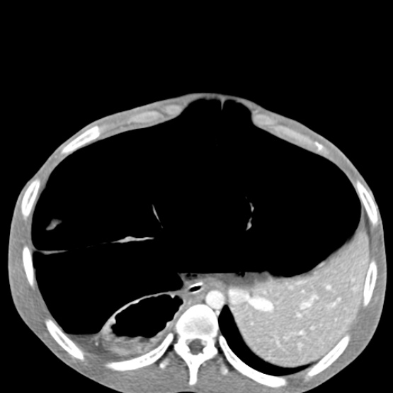 Chronic large bowel pseudo-obstruction (Radiopaedia 43181-46492 A 46).jpg