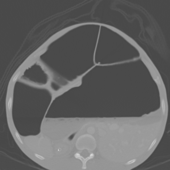 File:Chronic large bowel pseudo-obstruction (Radiopaedia 43181-46492 Axial bone window 63).jpg