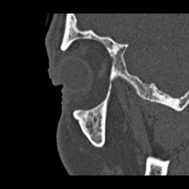 Chronic maxillary sinusitis (Radiopaedia 27879-28116 Sagittal bone window 54).jpg