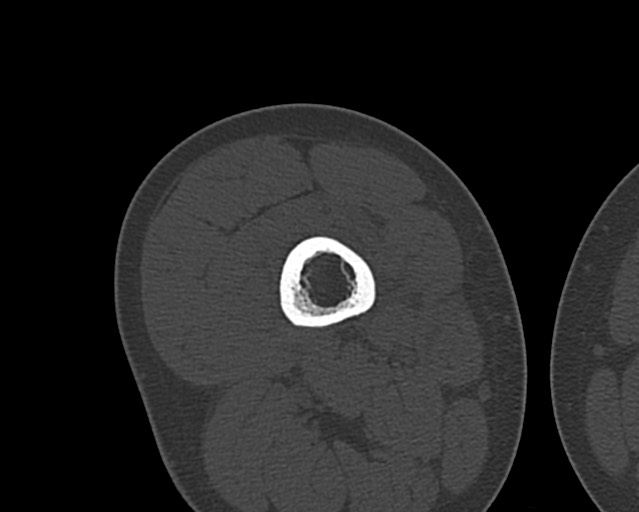Chronic ostemyelitis of the femur with long sinus tract (Radiopaedia 74947-85982 Axial bone window 109).jpg