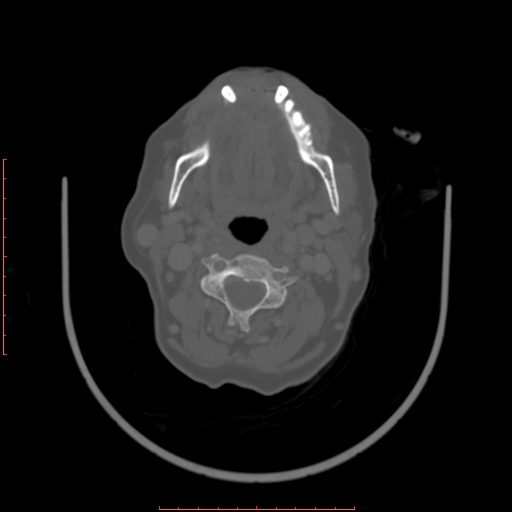 Chronic osteomyelitis - maxilla (Radiopaedia 23783-23927 Axial bone window 38).jpg