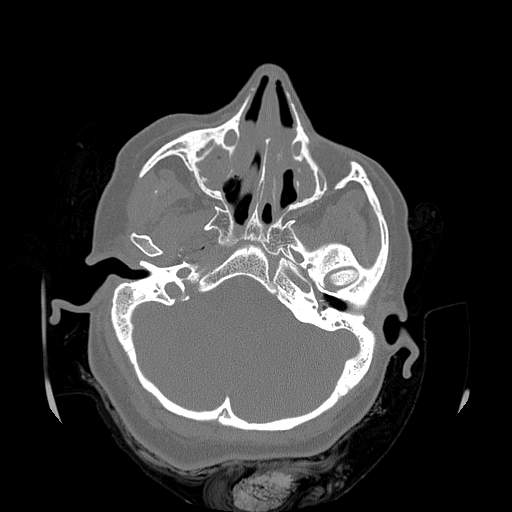 Chronic sinusitis with intra-sinus calcification (Radiopaedia 63919-72668 Axial bone window 44).jpg