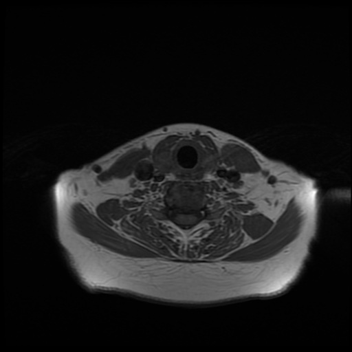 File:Chronic submandibular sialadenitis (Radiopaedia 61852-69885 Axial T1 24).jpg