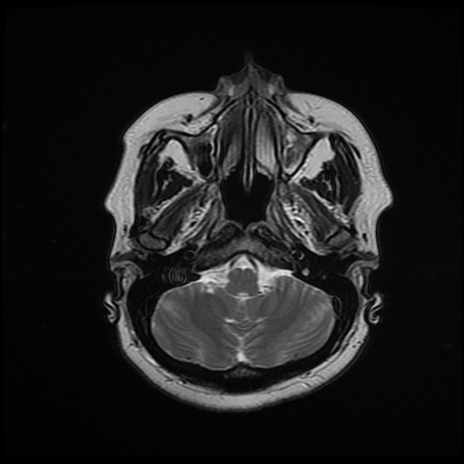 File:Chronic submandibular sialadenitis (Radiopaedia 61852-69885 Axial T2 3).jpg