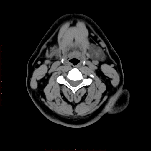 Chronic submandibular sialolithiasis (Radiopaedia 69817-79814 Axial non-contrast 131).jpg