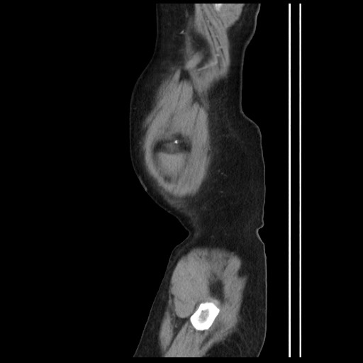 Chyluria following renal ablation (Radiopaedia 81087-94678 B 190).jpg