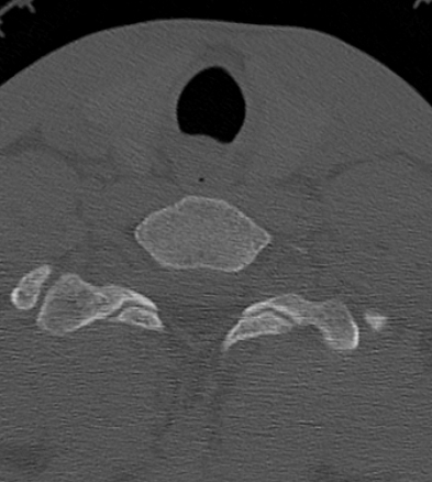 Clay-shoveler fracture (Radiopaedia 14604-14532 Axial bone window 42).jpg