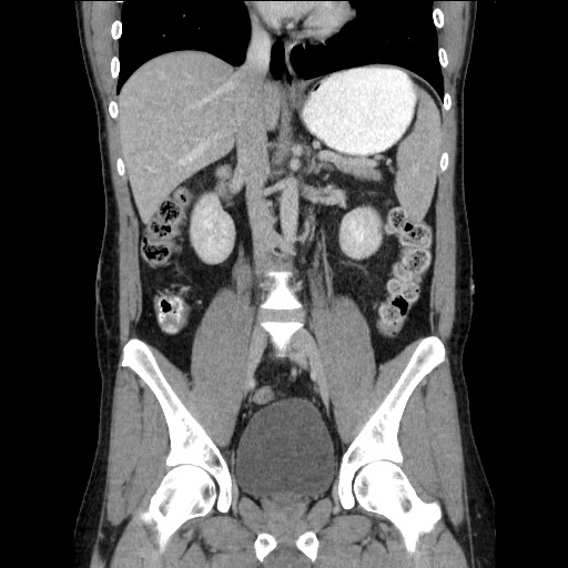 File:Closed-loop small bowel obstruction (Radiopaedia 73713-84509 C 68).jpg