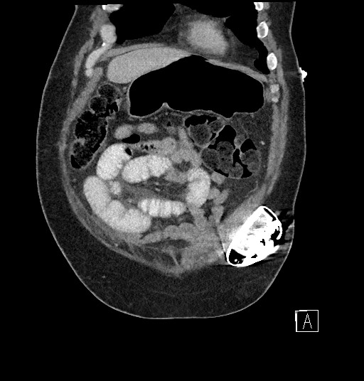 File:Closed loop obstruction - internal hernia into nephrectomy bed (Radiopaedia 59867-67320 B 18).jpg