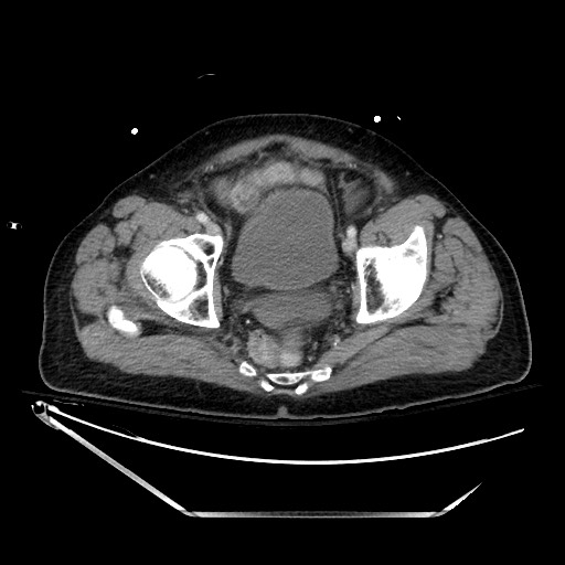 File:Closed loop obstruction due to adhesive band, resulting in small bowel ischemia and resection (Radiopaedia 83835-99023 Axial 462).jpg