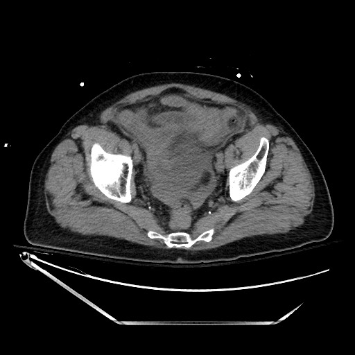 File:Closed loop obstruction due to adhesive band, resulting in small bowel ischemia and resection (Radiopaedia 83835-99023 Axial non-contrast 133).jpg