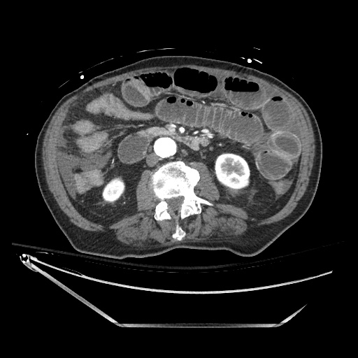 File:Closed loop obstruction due to adhesive band, resulting in small bowel ischemia and resection (Radiopaedia 83835-99023 B 73).jpg