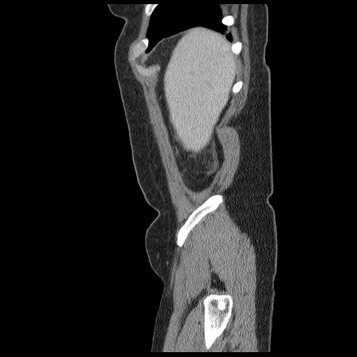 Closed loop small bowel obstruction (Radiopaedia 65403-74451 C 4).jpg