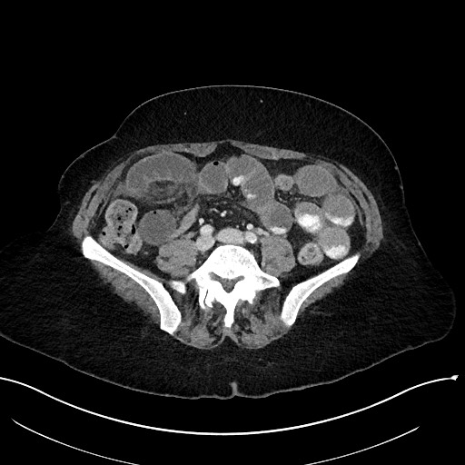 File:Closed loop small bowel obstruction - adhesions (Radiopaedia 59078-66369 Axial 16).jpg