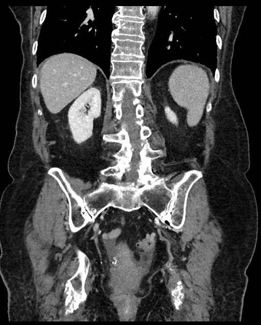 Closed loop small bowel obstruction - adhesions (Radiopaedia 59269-66611 B 90).jpg