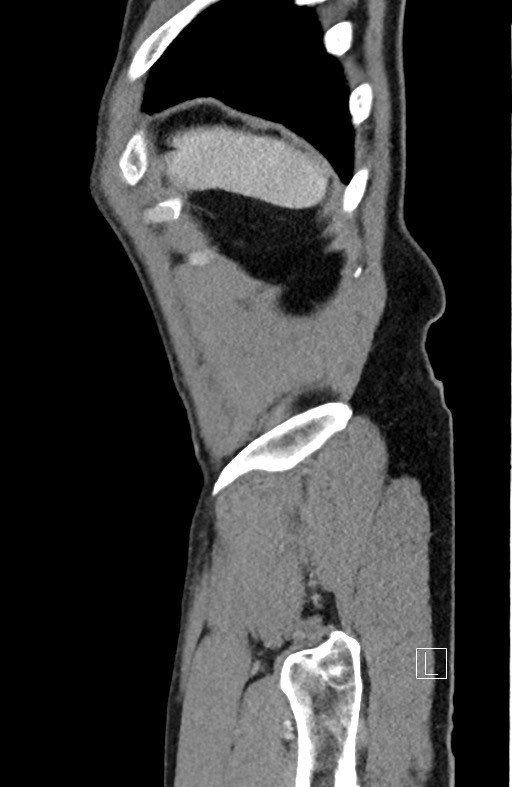 Closed loop small bowel obstruction - internal hernia (Radiopaedia 57806-64778 C 15).jpg