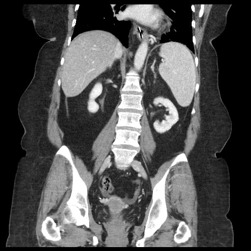 Closed loop small bowel obstruction - internal hernia (Radiopaedia 65402-74450 B 69).jpg