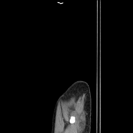 Closed loop small bowel obstruction - omental adhesion causing "internal hernia" (Radiopaedia 85129-100682 C 178).jpg