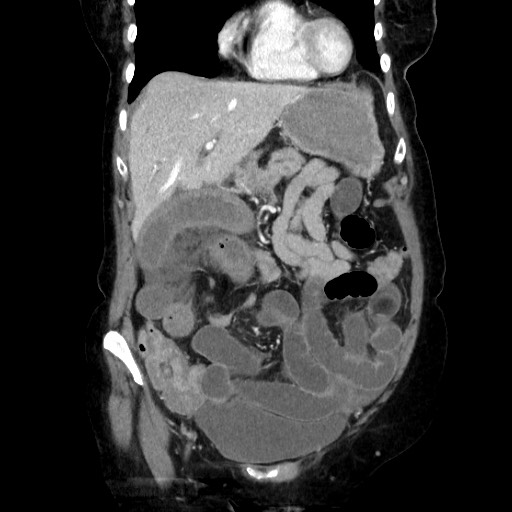 Closed loop small bowel obstruction due to adhesive band, with intramural hemorrhage and ischemia (Radiopaedia 83831-99017 C 42).jpg