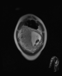 File:Closed loop small bowel obstruction in pregnancy (MRI) (Radiopaedia 87637-104031 Coronal T2 12).jpg