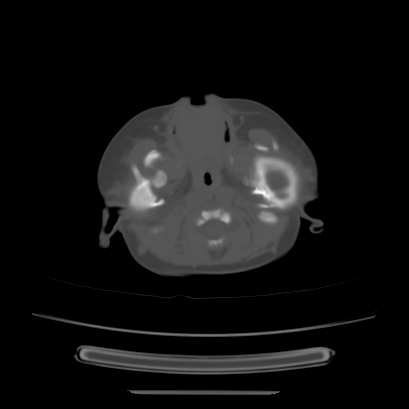 Cloverleaf skull (Radiopaedia 91901-109710 Axial bone window 37).jpg