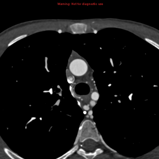 File:Coarctation of the aorta (Radiopaedia 12461-12697 A 111).jpg