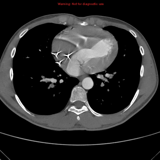 File:Coarctation of the aorta (Radiopaedia 9434-10118 A 121).jpg