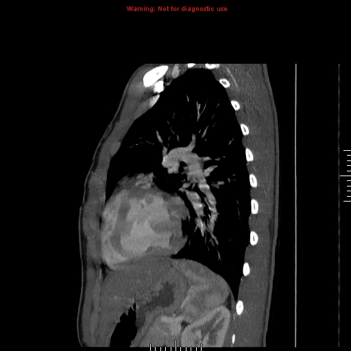 File:Coarctation of the aorta (Radiopaedia 9434-10118 B 43).jpg