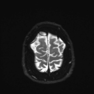Cochlear incomplete partition type III associated with hypothalamic hamartoma (Radiopaedia 88756-105498 Axial DWI 38).jpg
