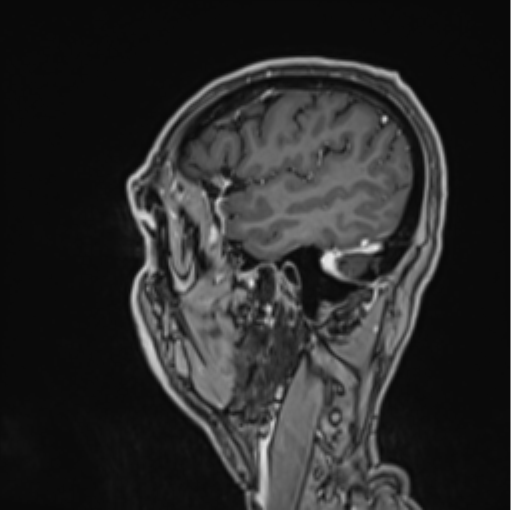 Colloid cyst of the third ventricle (Radiopaedia 86571-102662 Sagittal T1 C+ 14).png
