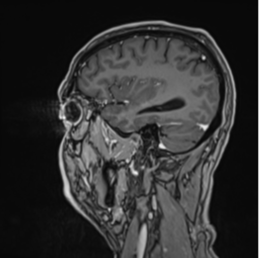File:Colloid cyst of the third ventricle (Radiopaedia 86571-102662 Sagittal T1 C+ 20).png