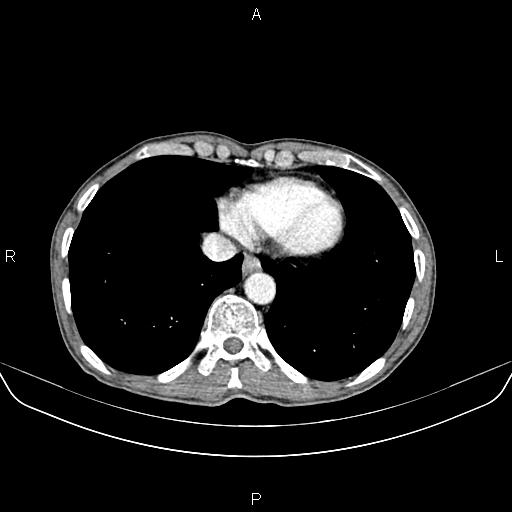 Colon adenocarcinoma - hepatic flexure (Radiopaedia 85635-101395 A 8).jpg