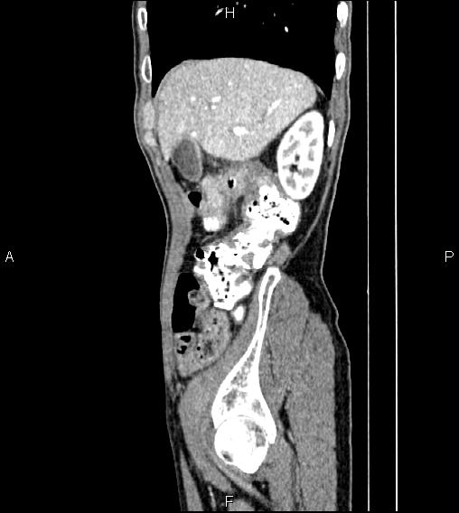 Colon adenocarcinoma - hepatic flexure (Radiopaedia 85635-101395 D 17).jpg